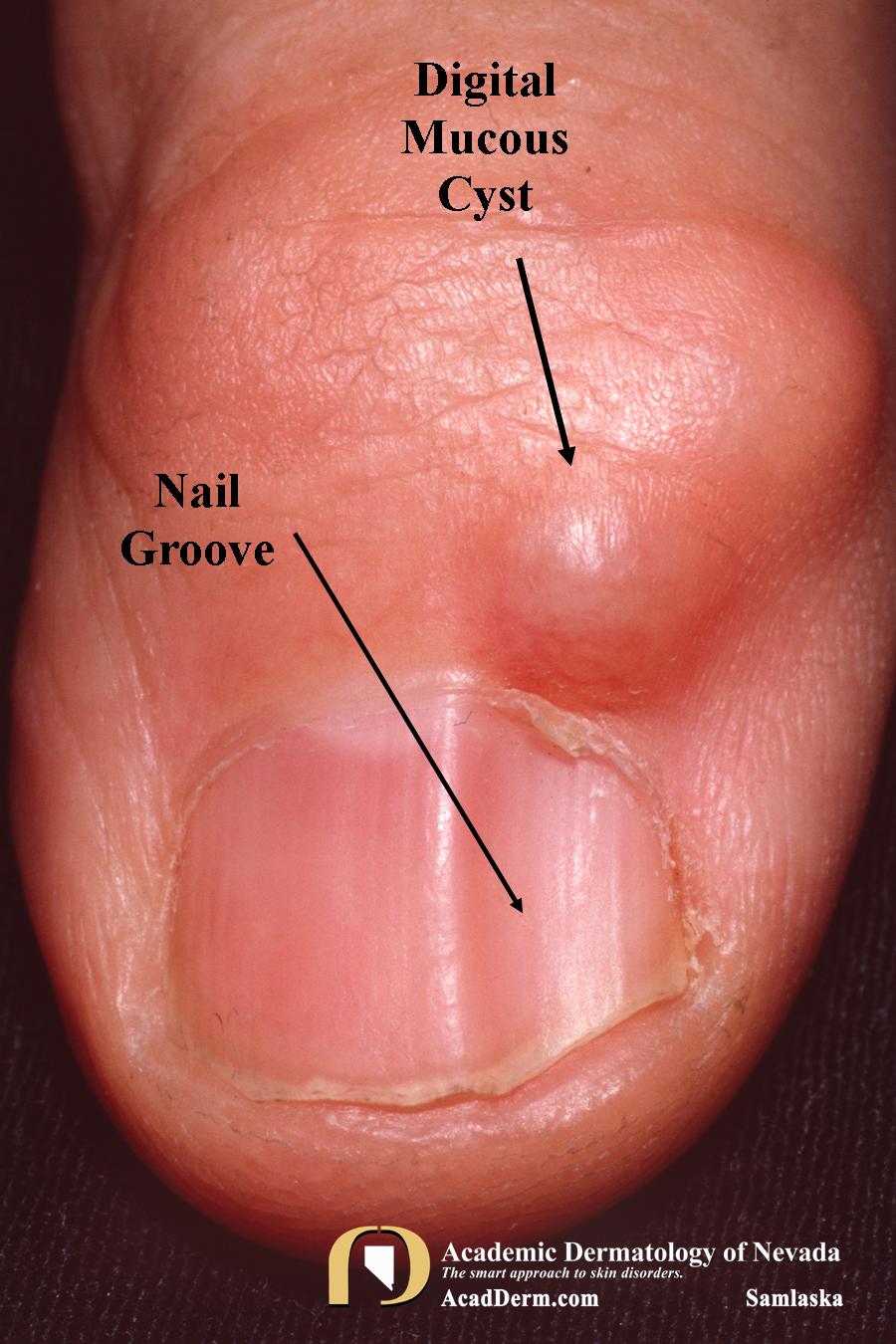 Digital Mucous Cyst (DMC):  Myxoid Cyst…