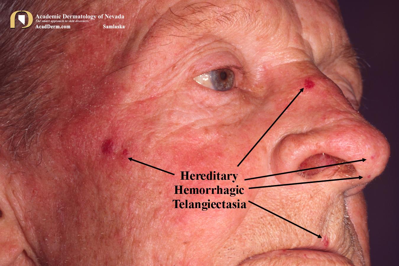 Hereditary Hemorrhagic Telangiectasia:  Osler-Weber-Rendu…