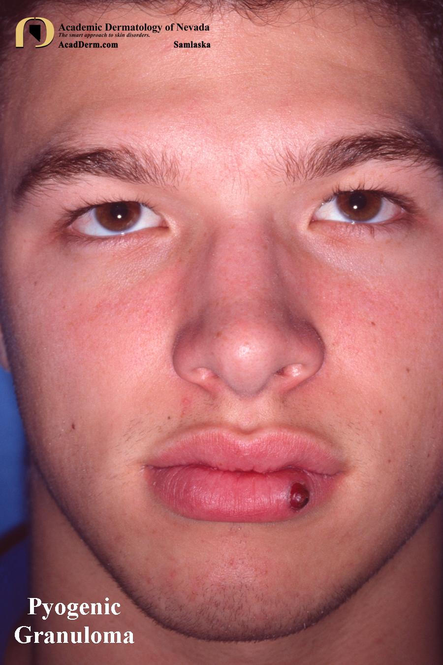 Pyogenic Granuloma:  Lobular Capillary Hemangioma…