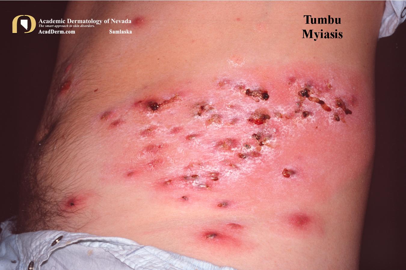 Tumbu Myiasis:  Cordylobia Anthropophaga…