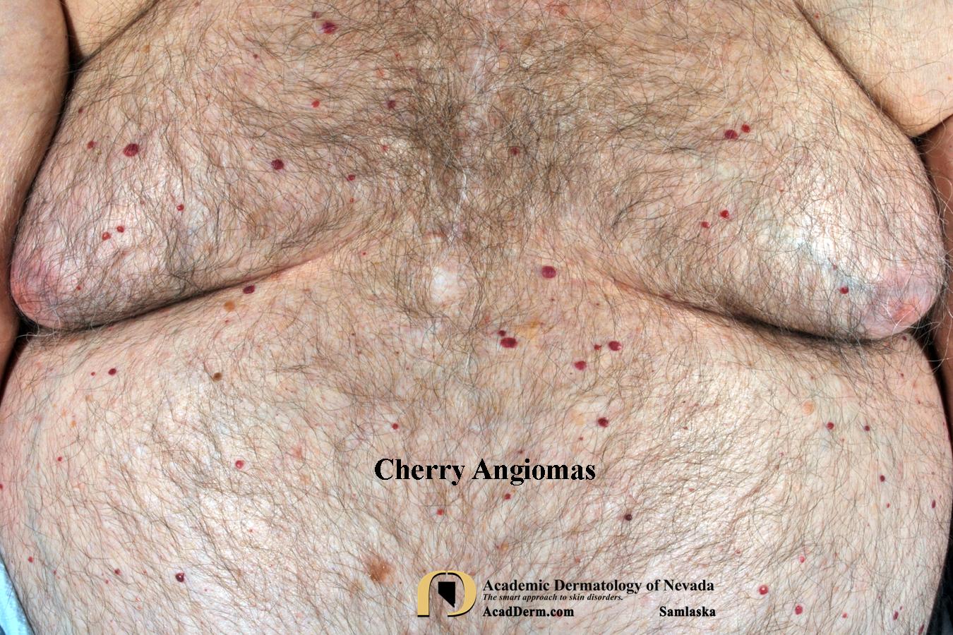 Cherry Angioma:  Senile Angioma…