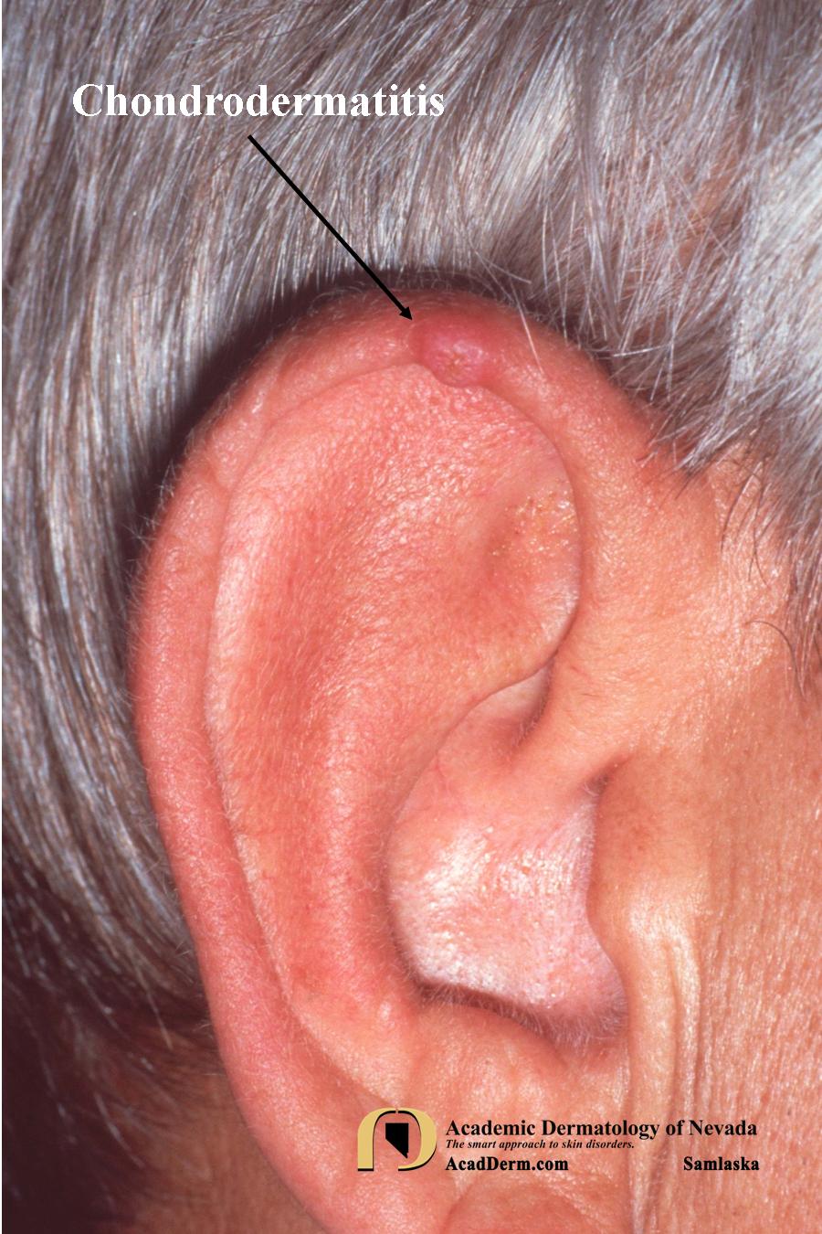 Chondrodermatitis:  Chondrodermatitis Nodularis Helicis…