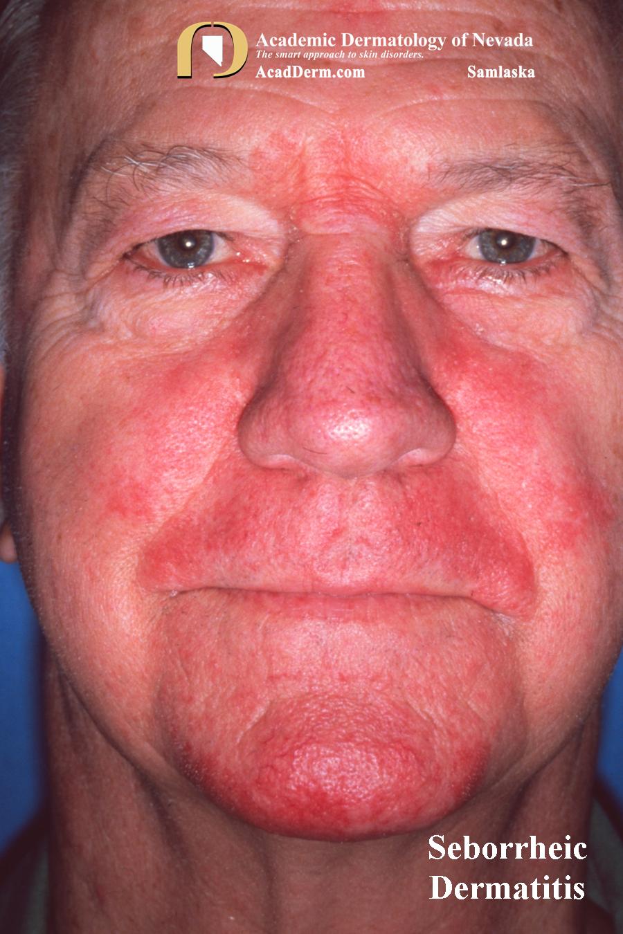 Seborrheic Dermatitis:  Dandruff, Cradle Cap…