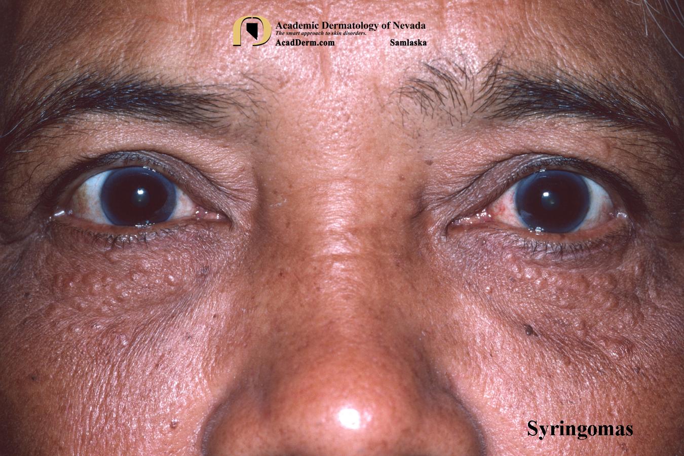 Syringoma:  Tadpoles in the skin…