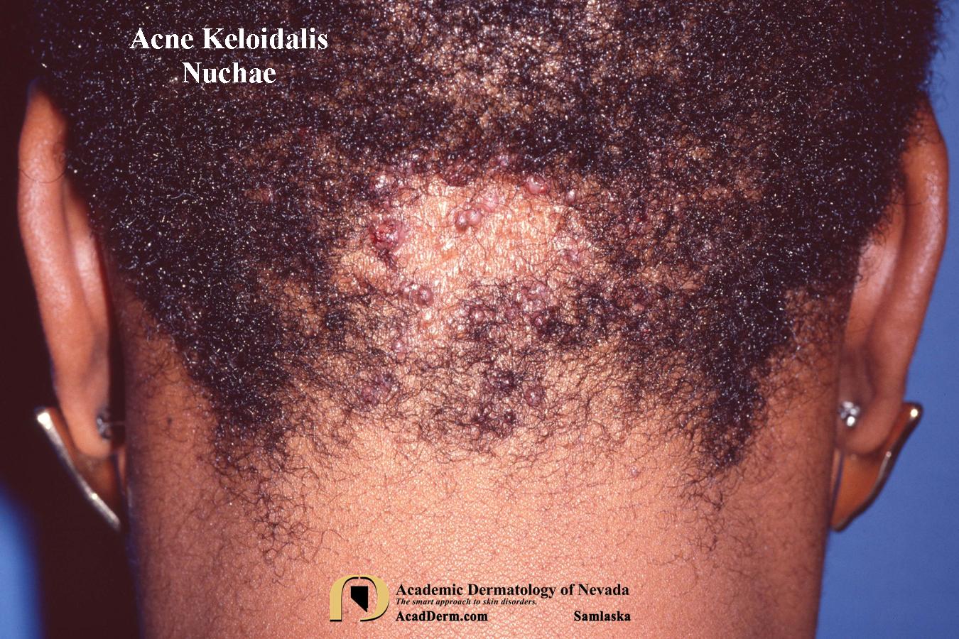 Acne Keloidalis Nuchae (AKN):  Folliculitis Keloidalis…