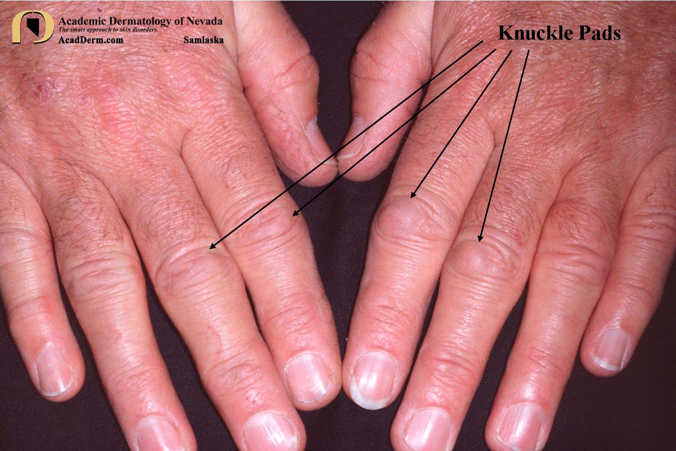 Knuckle Pads:  Heloderma…