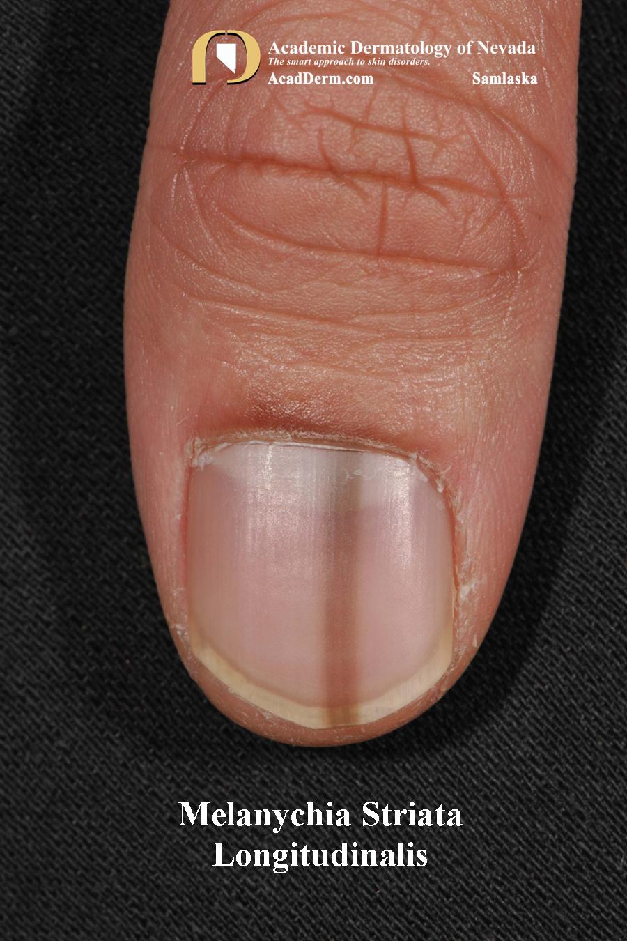 Melanonychia Striata Longitudinalis (MSL):  Pigmented bands…