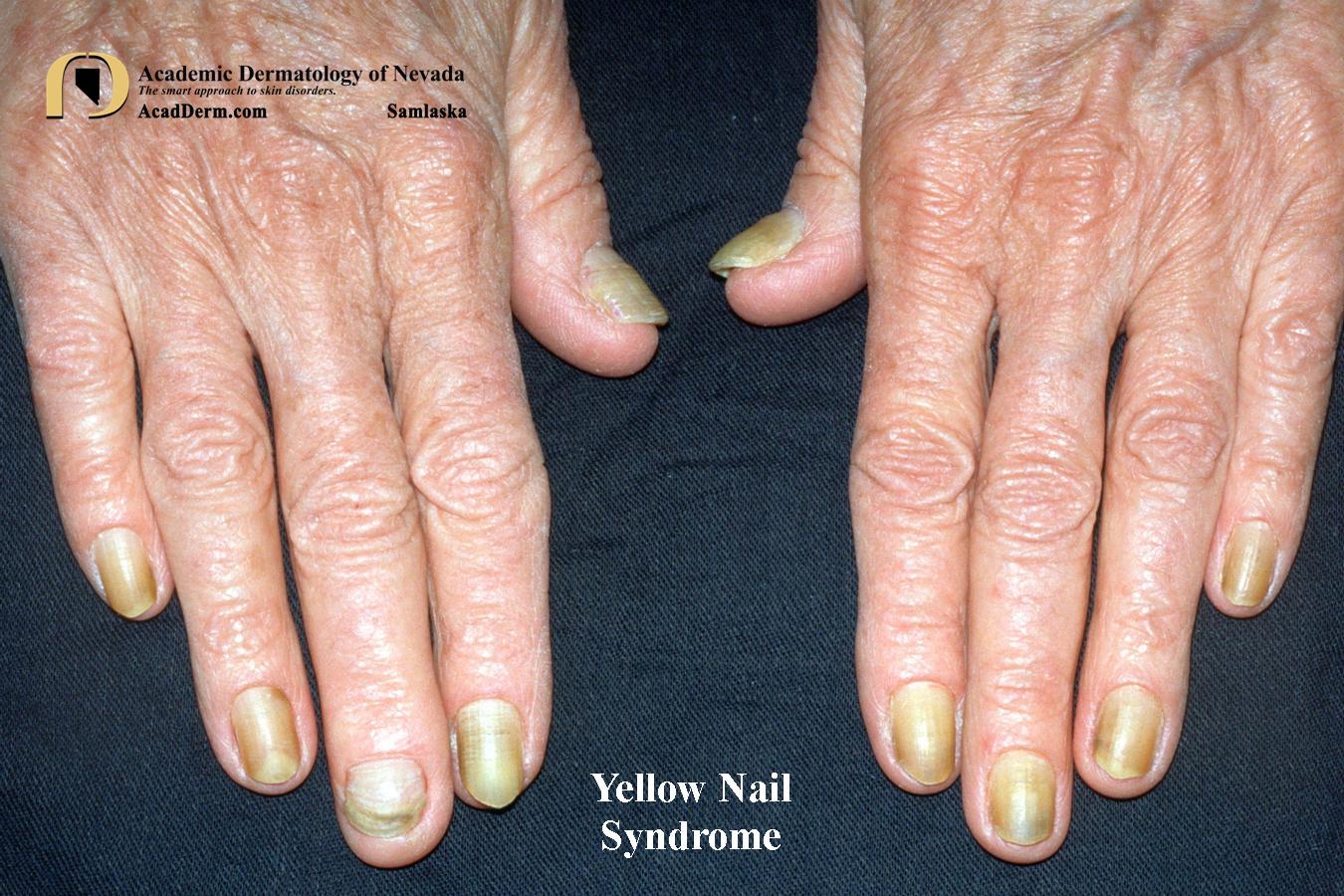 Yellow Nail Syndrome:  Yellow Nails, Lymphedema, Bronchiectasis, Pleural Effusions and Sinusitis…