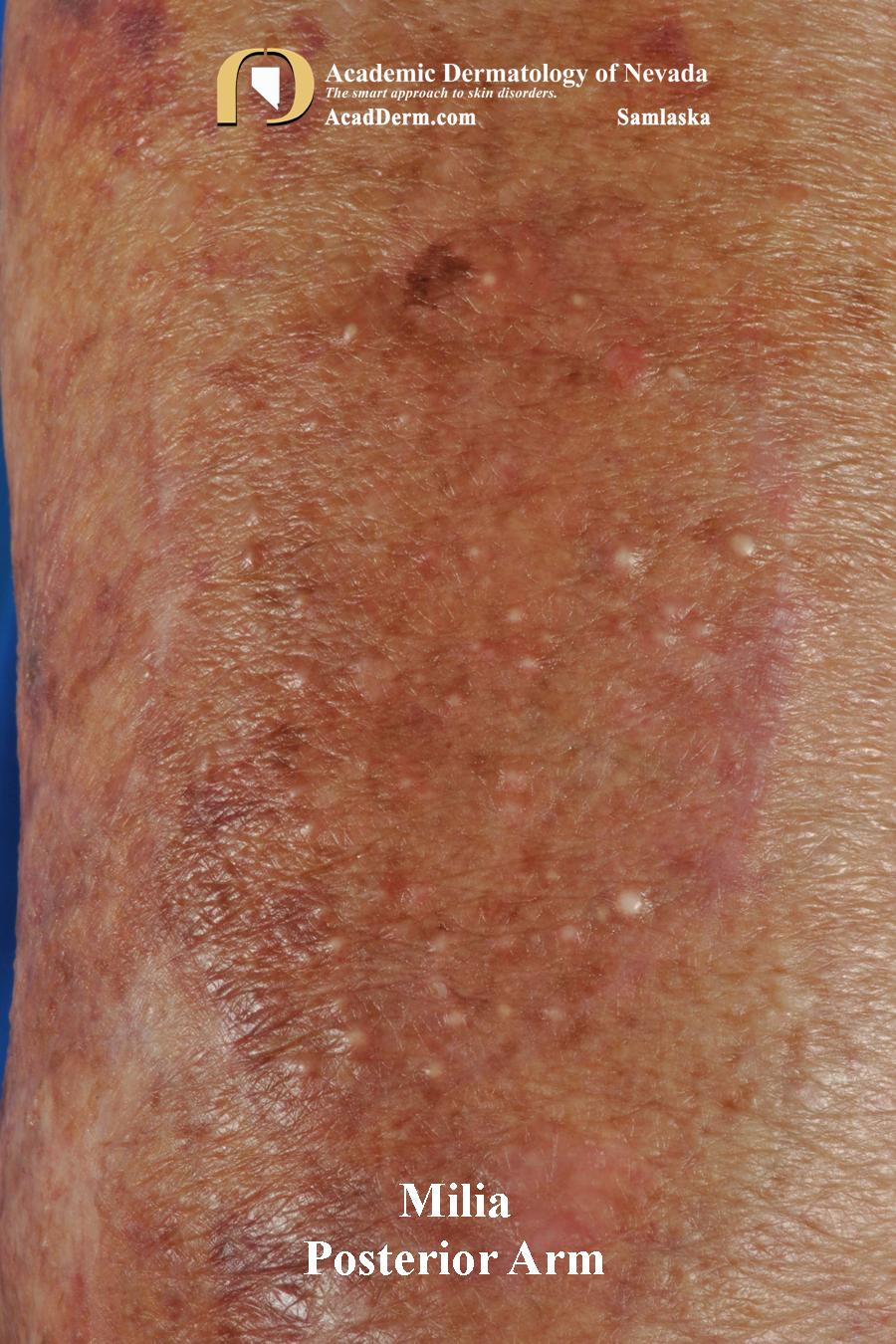 Milia:  Milium, Milia En Plaque…