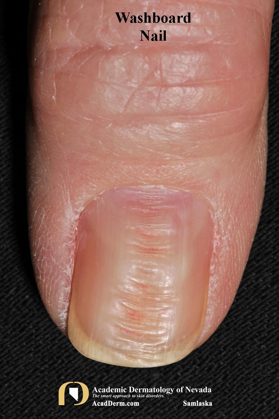 Nail Trauma:  Washboard Nails, Nail Biting…