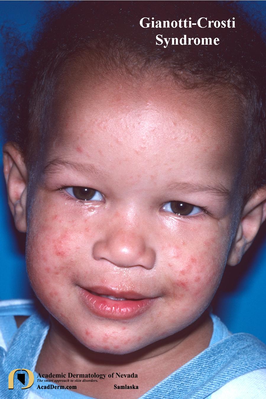 Gianotti-Crosti Syndrome:  Papular Acrodermatitis of Childhood…