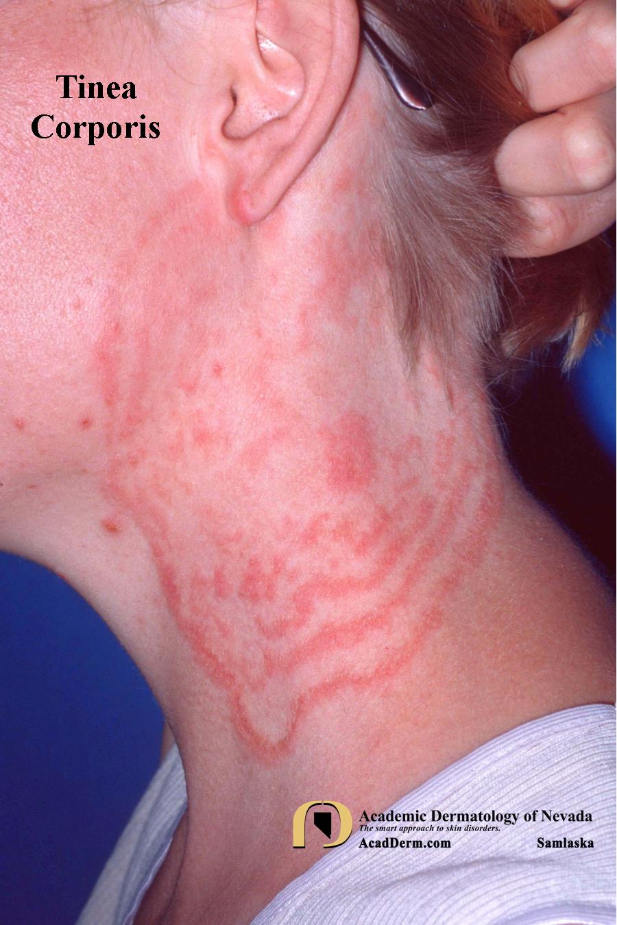 Tinea Corporis:  Ringworm, Tinea Circinata…