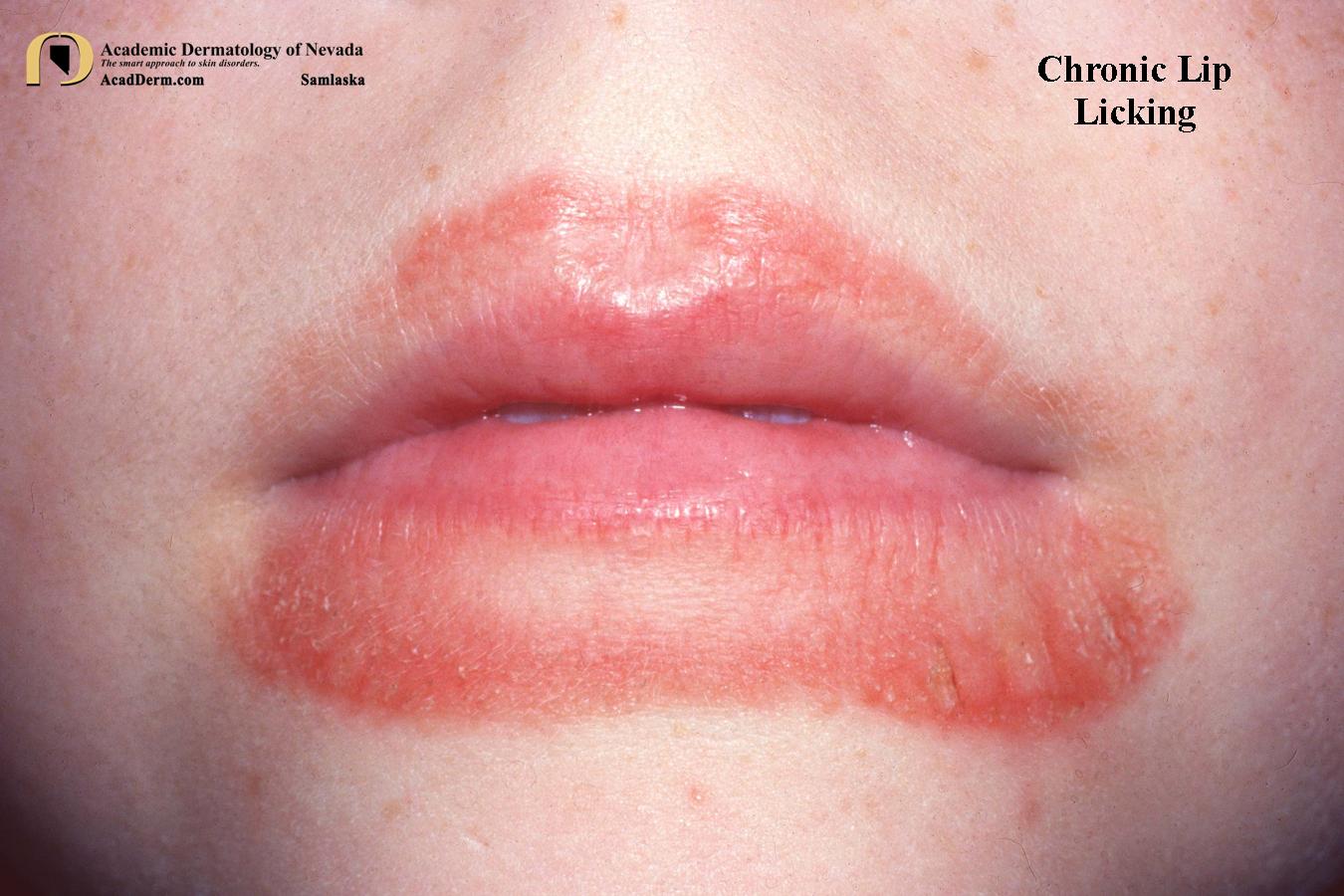 Chronic Lip Licking:  Exfoliative Cheilitis…