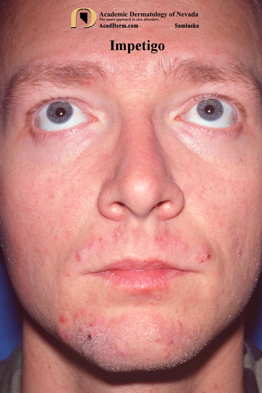 Impetigo:  Impetigo Contagiosa…