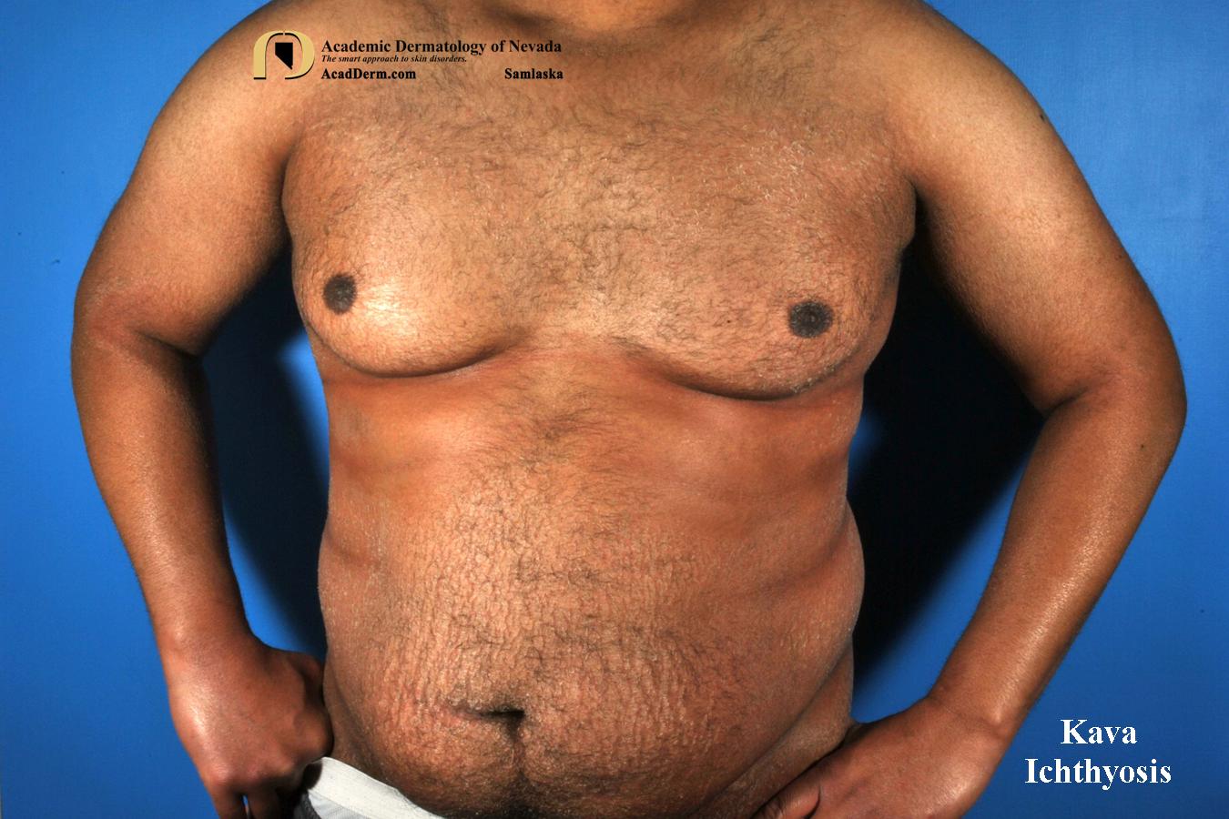 Kava Dermopathy:  Kava Ichthyosis, Crocodile Skin…