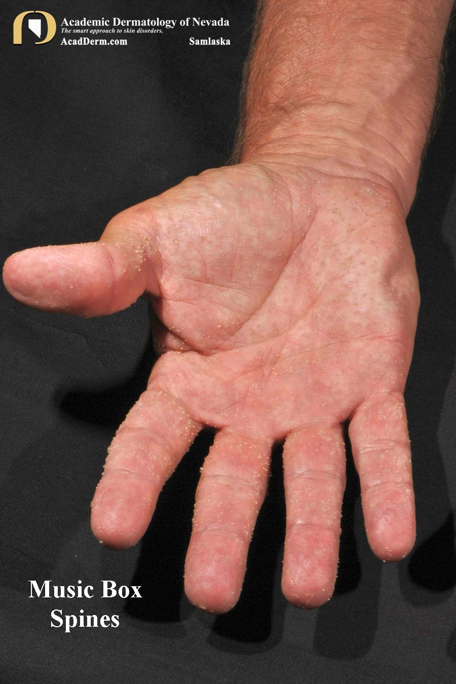 Music Box Spine Keratoses:  Punctate Keratoses of the Palms & Soles…