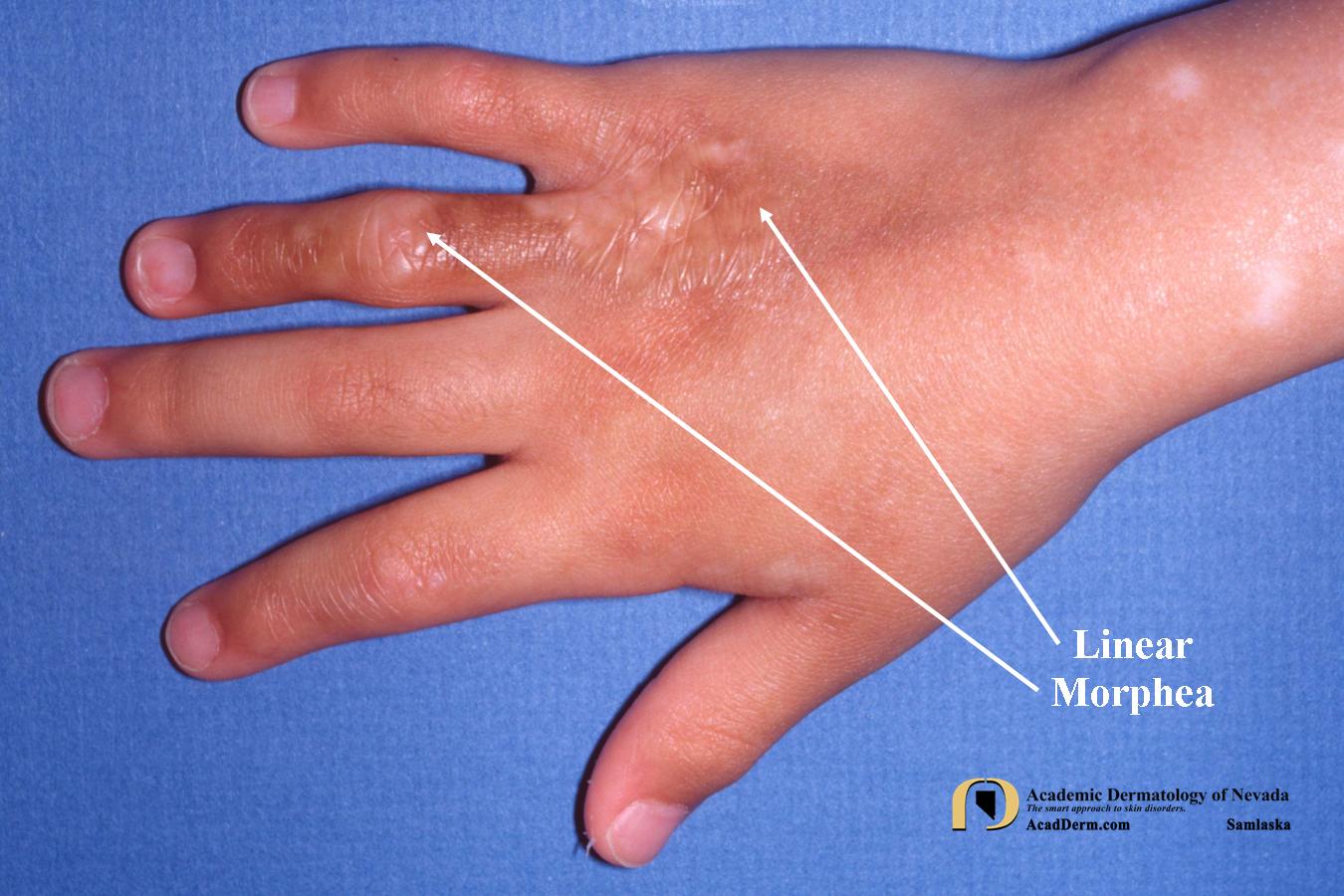 Linear Morphea:  Linear scleroderma…