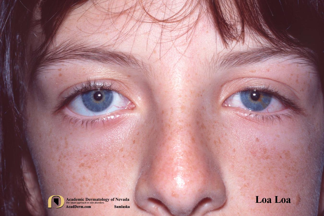 Loiasis:  Loa Loa, Tropical Swelling…