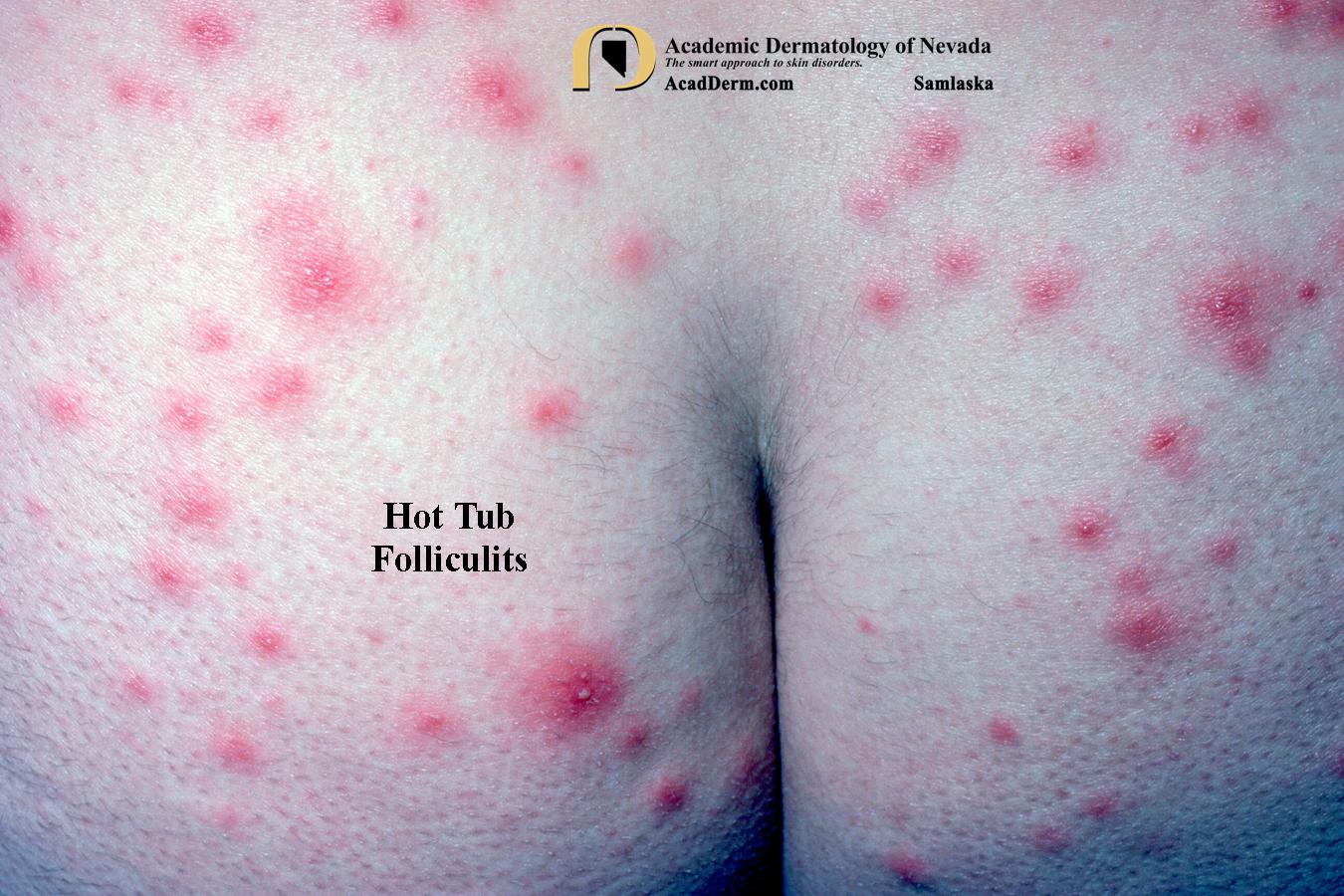 Hot Tub Folliculitis:  Spa Pool Folliculitis…