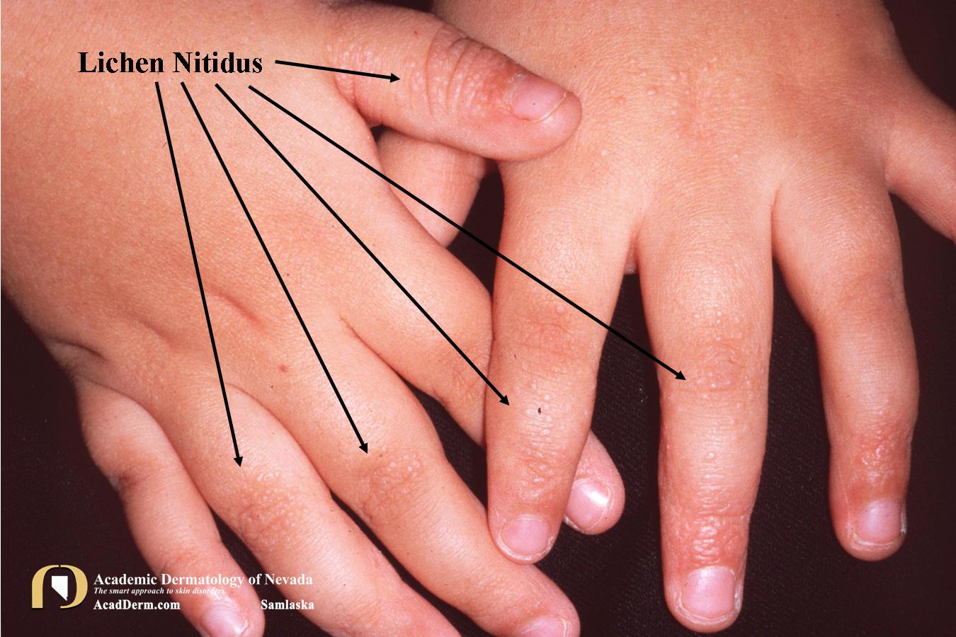 Lichen Nitidus:  The Ball and Claw…