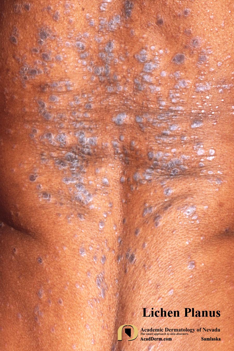 Lichen Planus:  Tree moss on a flat and even surface…