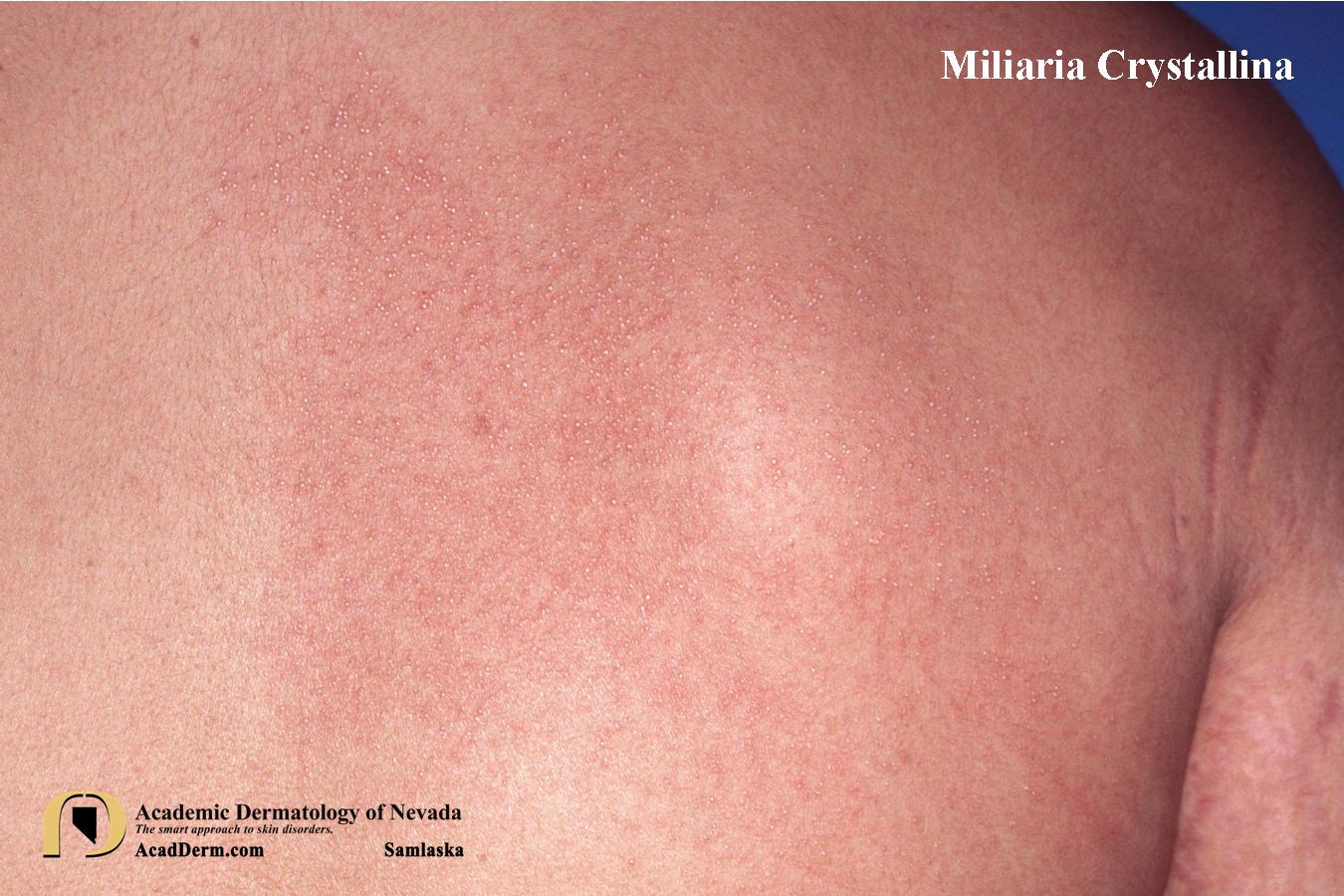 Miliaria Crystallina:  Sudamina…