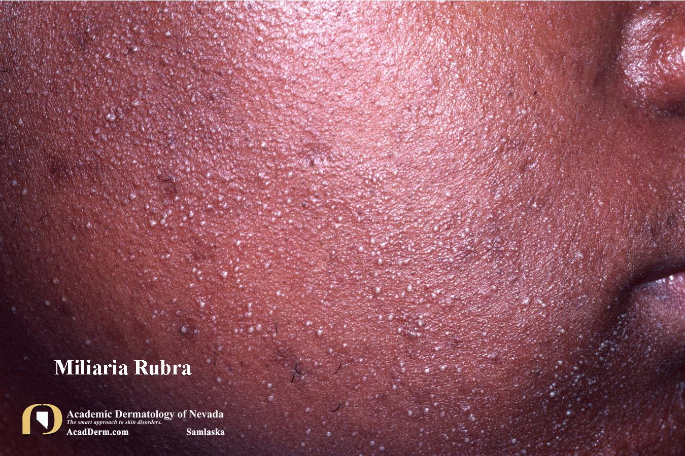 Miliaria Rubra:  Heat Rash, Prickly Heat…