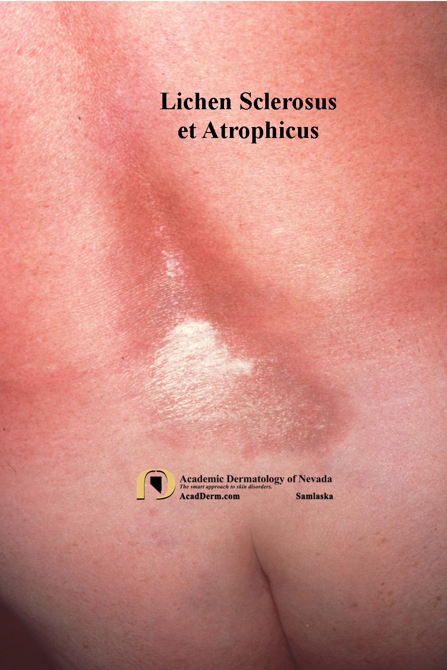 Lichen Sclerosus:  Lichen Sclerosus et Atrophicus, Kraurosis Vulvae, Balanitis Xerotica Obliterans…