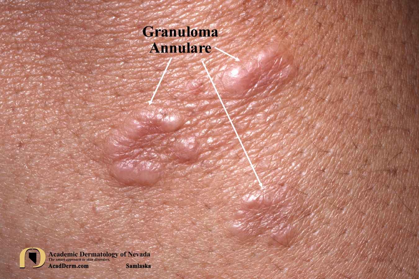 Granuloma Annulare:  Palisaded Granulomatous Dermatoses…