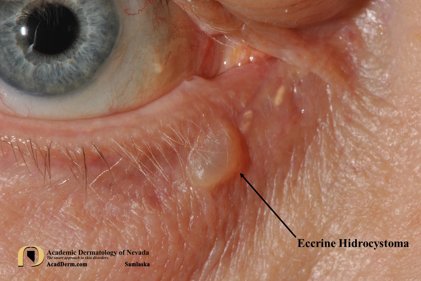 Eccrine Hidrocystomas:  Dilated Sweat Duct or Gland…