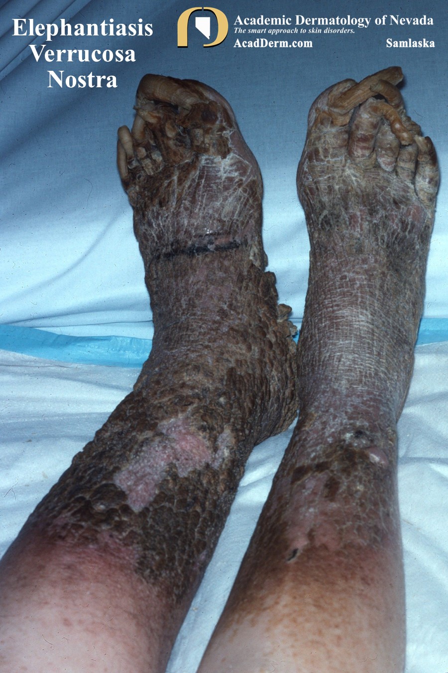 Elephantiasis Verrucosa Nostra: Mossy foot…