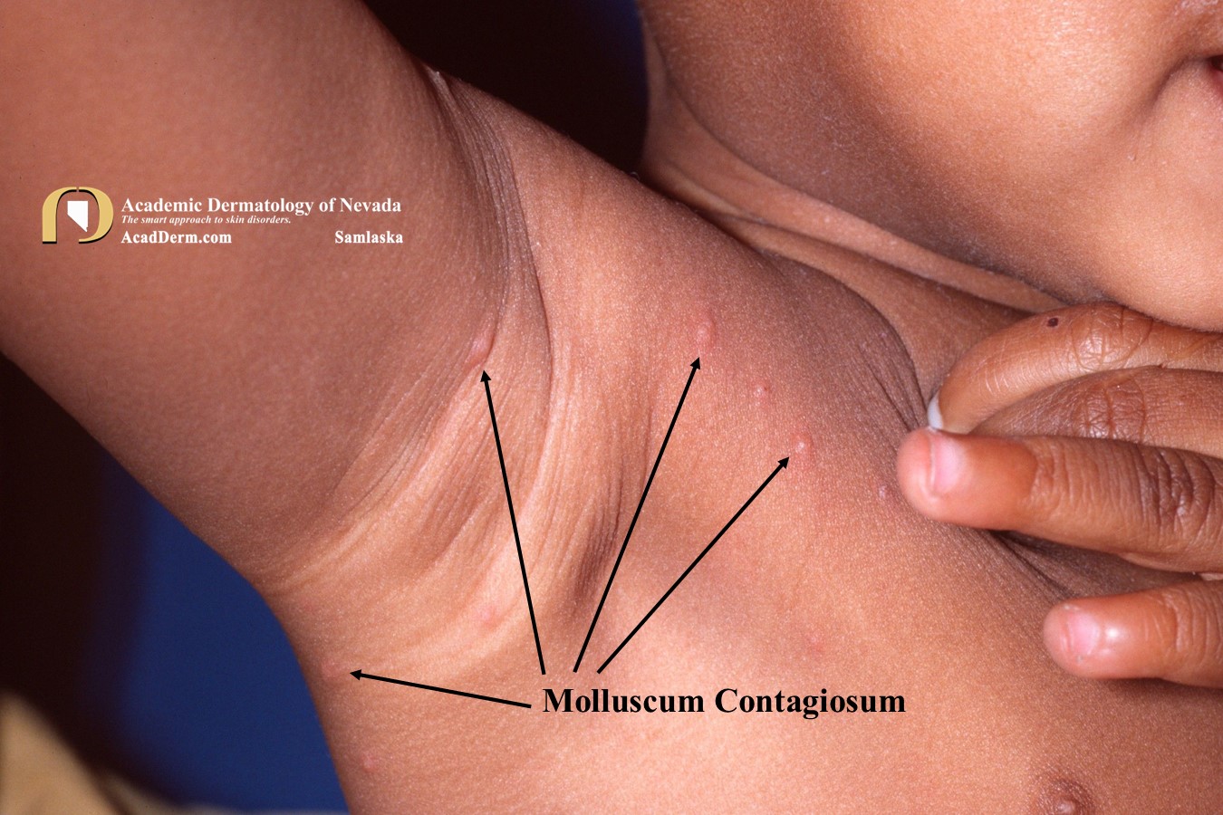 Molluscum Contagiosum:  Water Warts…