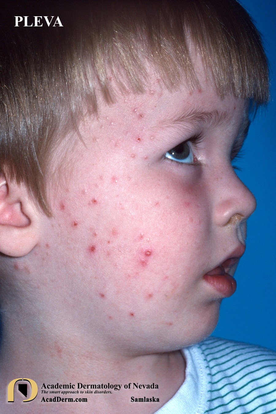 PLEVA:  Pityriasis Lichenoides et Varioliformis Acuta…