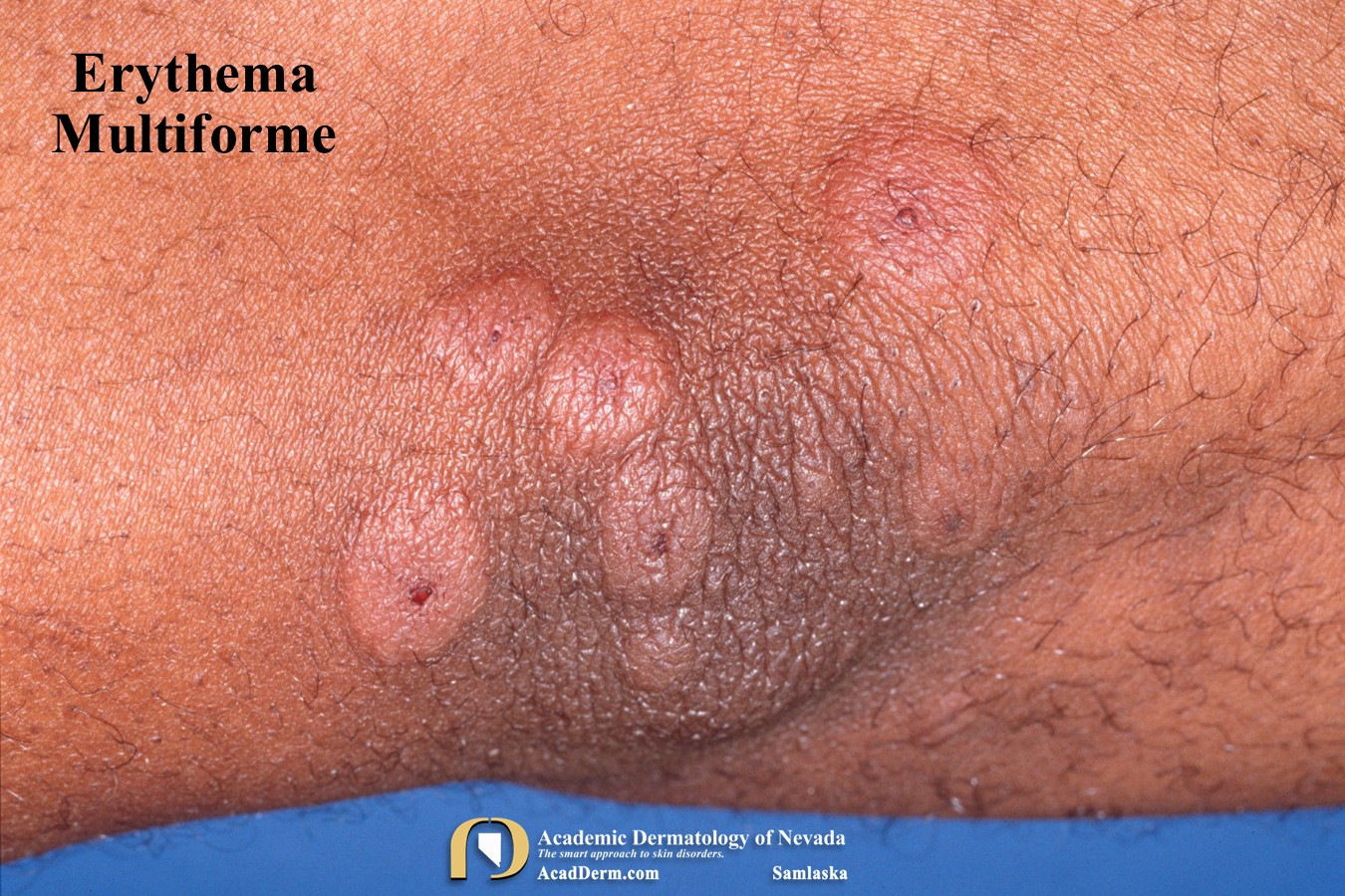 Erythema Multiforme:  Erythema Exudativum Multiforme…
