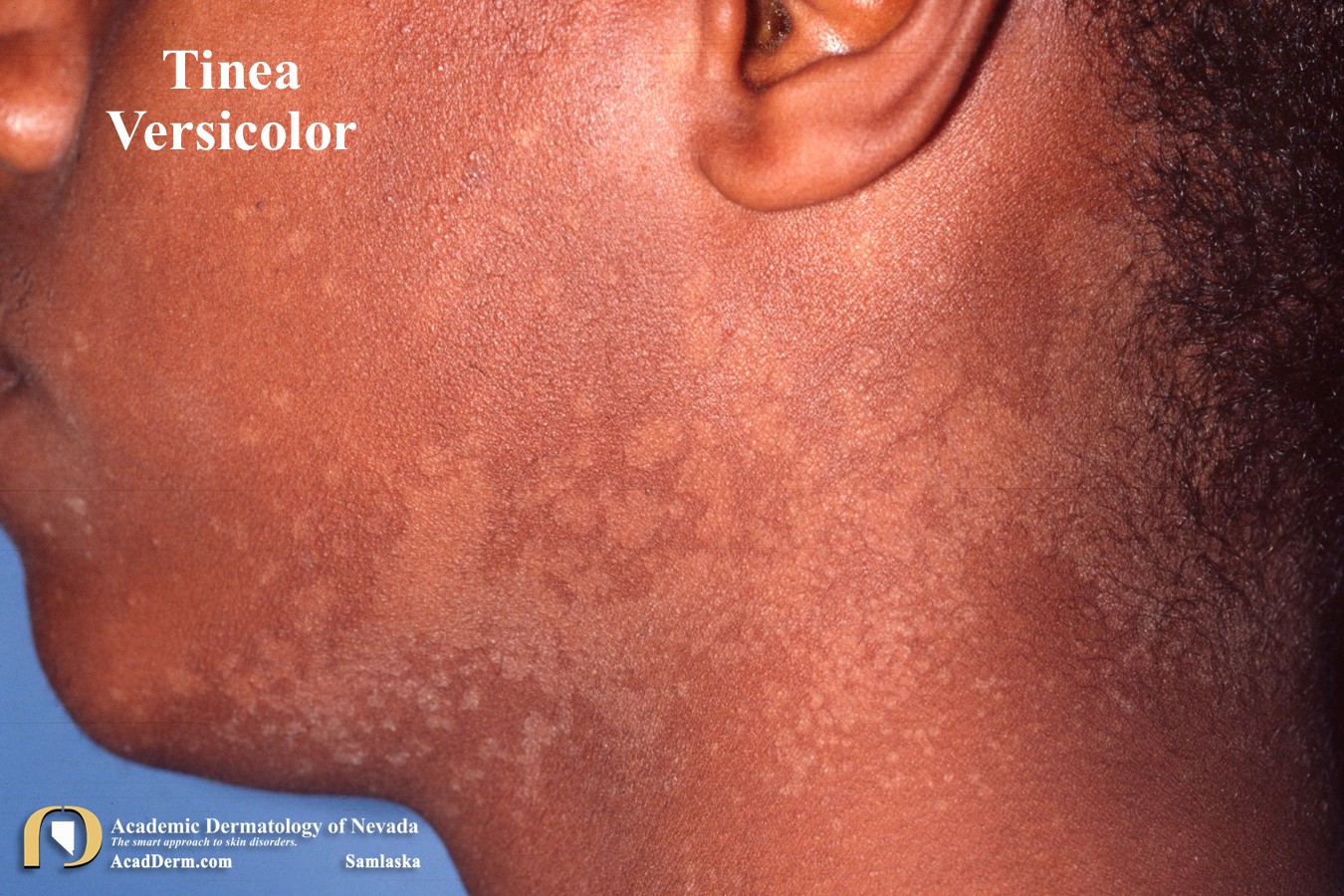 Tinea Versicolor:  Pityriasis Versicolor…