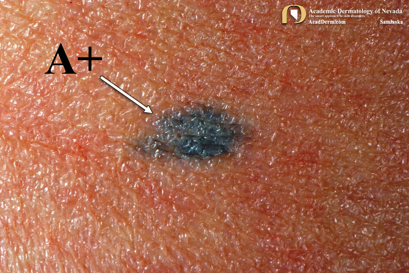 Atomic Tattoo:  Blood-type tattoos during the Cold War…