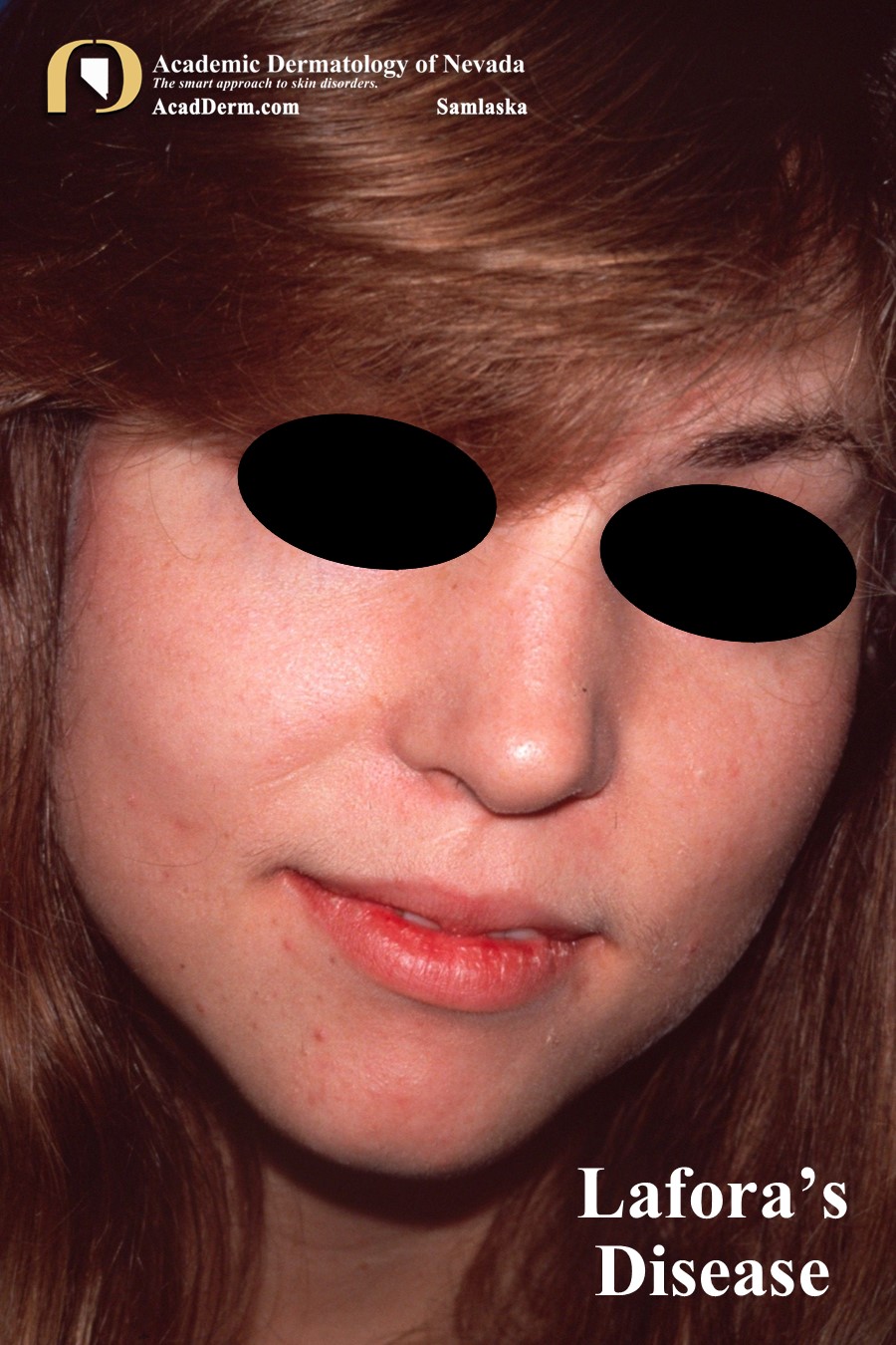 Lafora’s Disease:  Progressive Myoclonus Epilepsy…