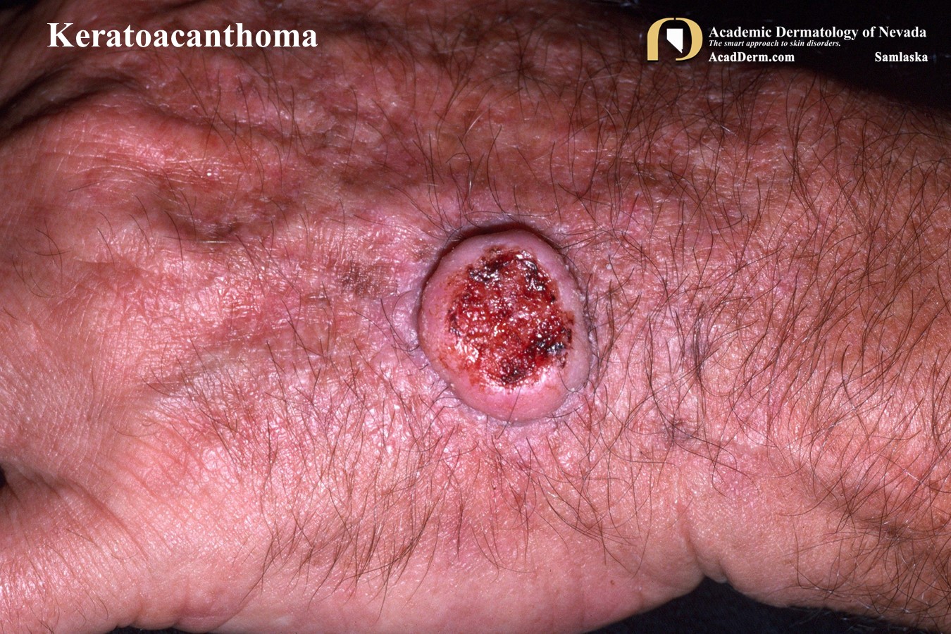 Keratoacanthoma:  Low Grade Squamous Cell Carcinomas…