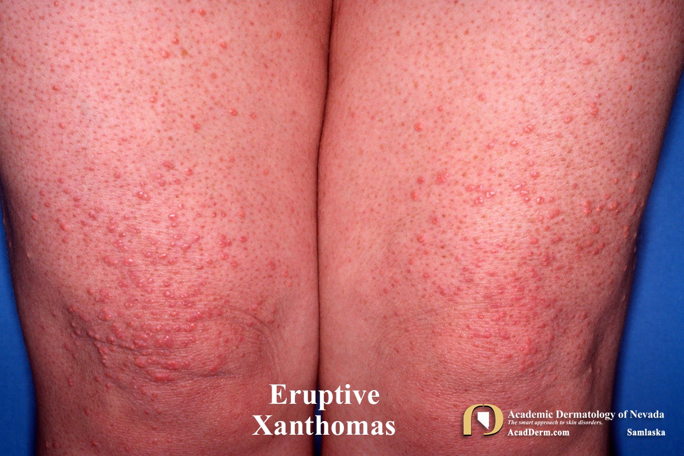 Xanthomas:  Signs of Dyslipidemia…