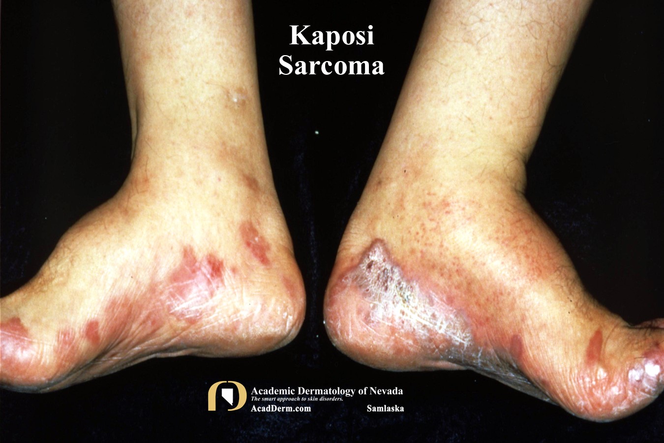 Kaposi Sarcoma:  The Old & The New…