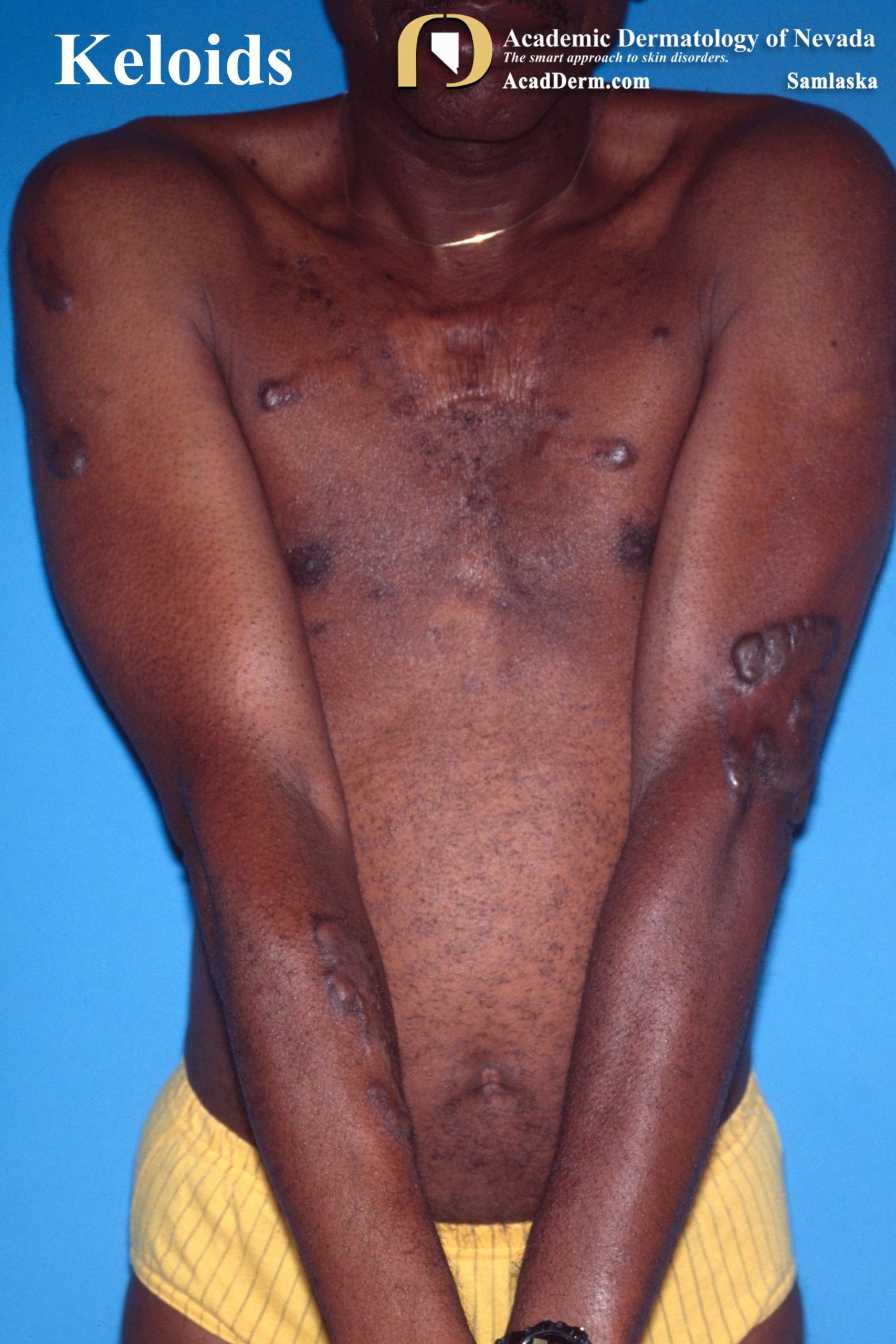 Keloids:  Beyond the Margins…