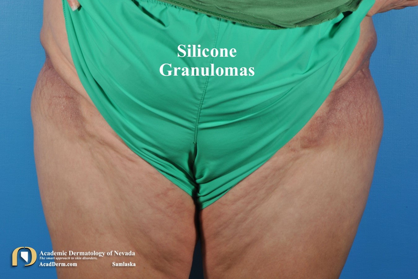 Silicone Granulomas:  Body Contouring Disasters…
