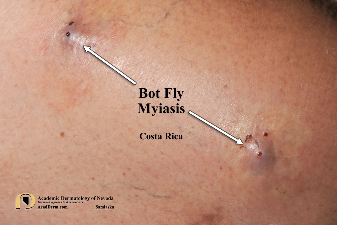 Bot Fly Myiasis:  What’s eating me…