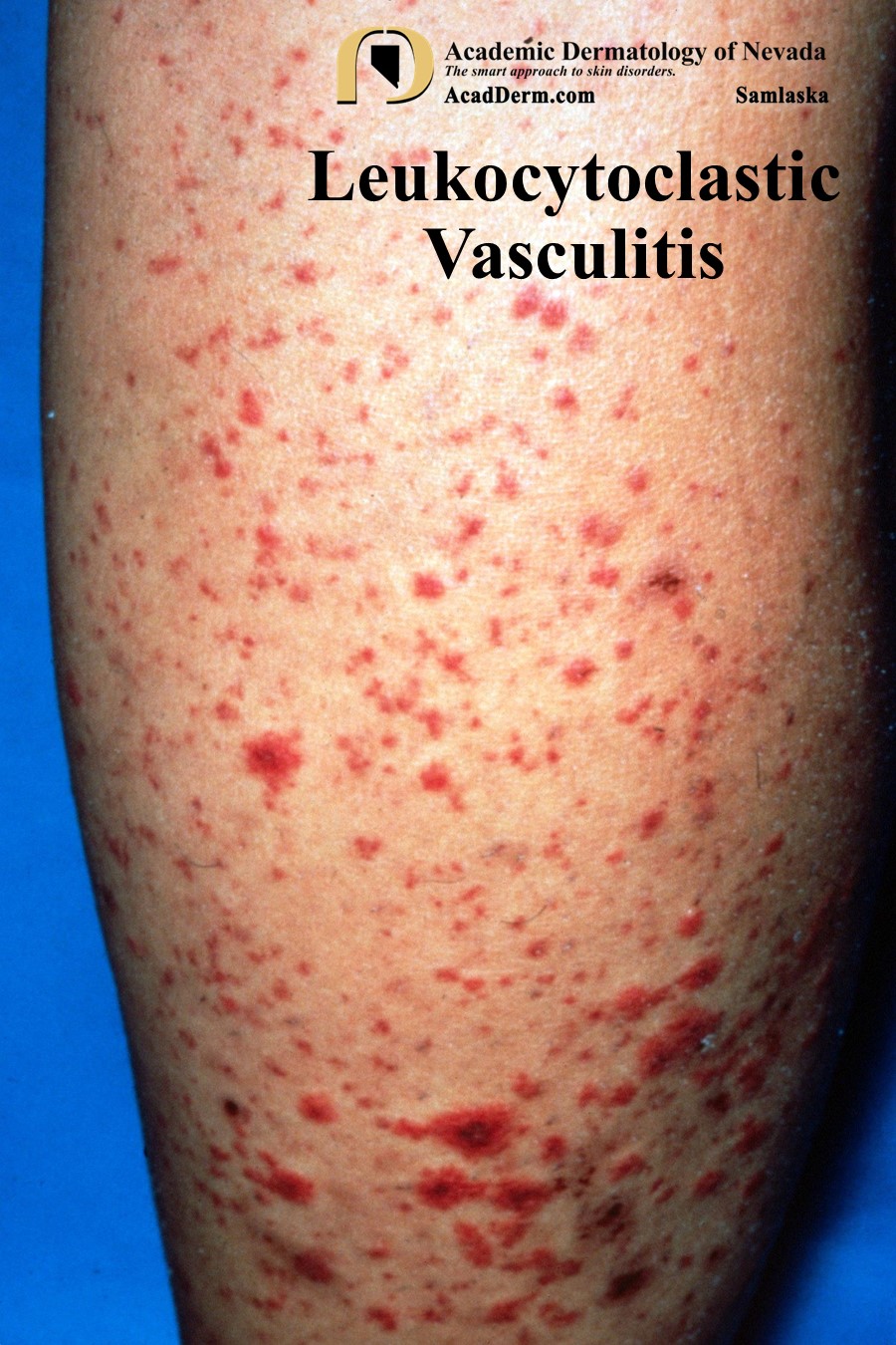 Leukocytoclastic Vasculitis:  Small-Vessel Vasculitis…