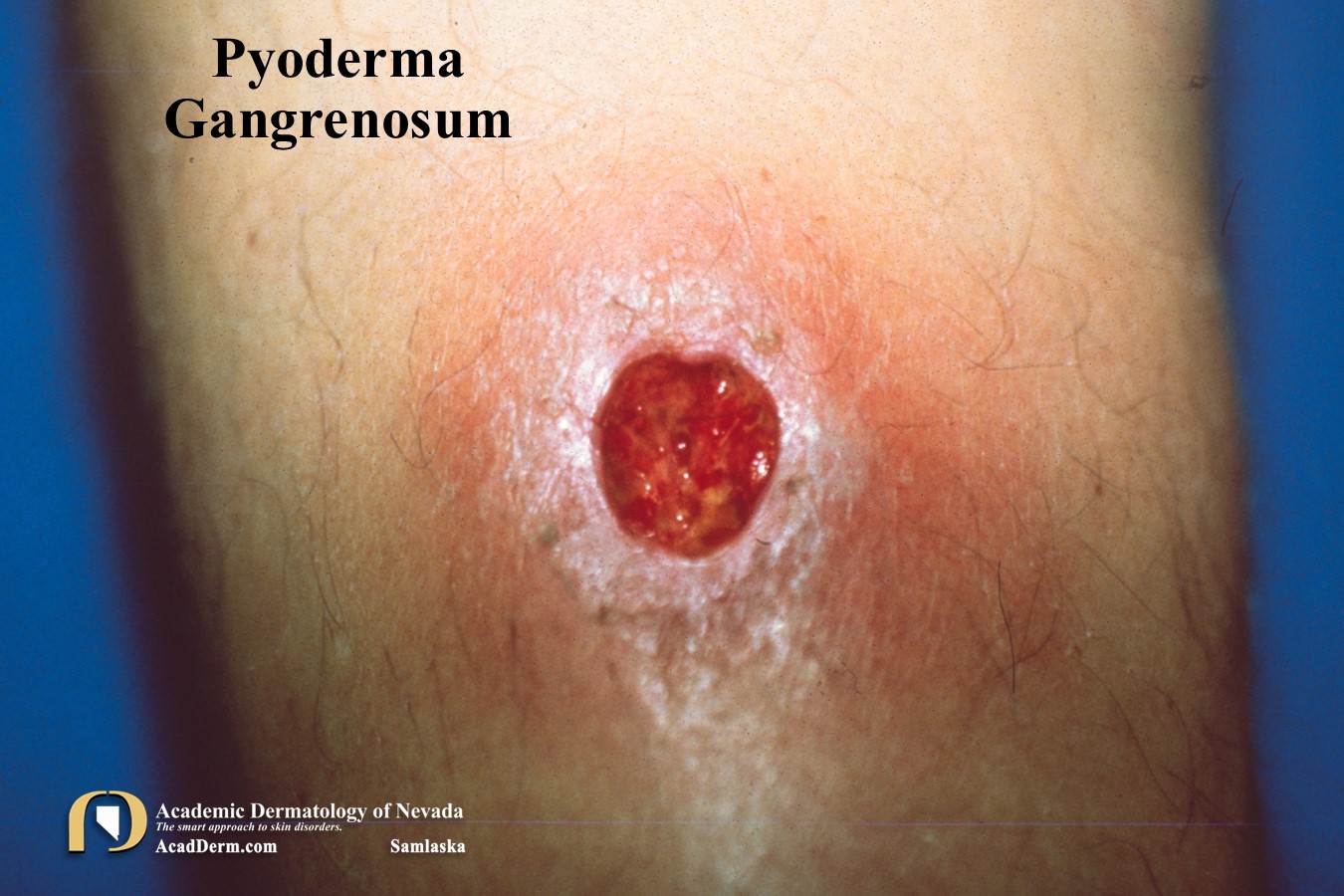 Pyoderma Gangrenosum:  It’s not an infection…