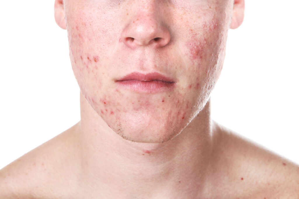 Teenager with Acne - Academic Dermatology of Nevada