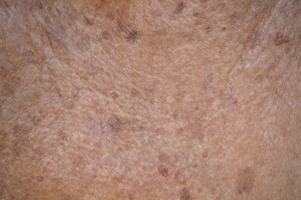 actinic keratosis or melanoma and seborrheic keratosis on collar - Academic Dermatology of Nevada
