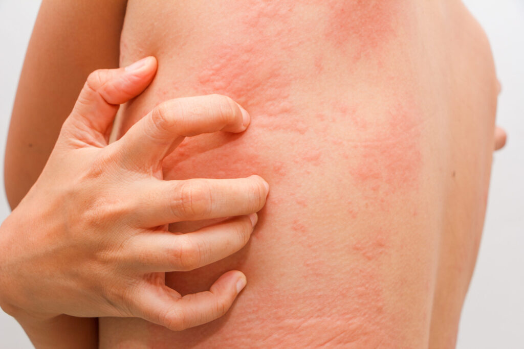 Women with symptoms of itchy urticaria - Academic Dermatology of Nevada