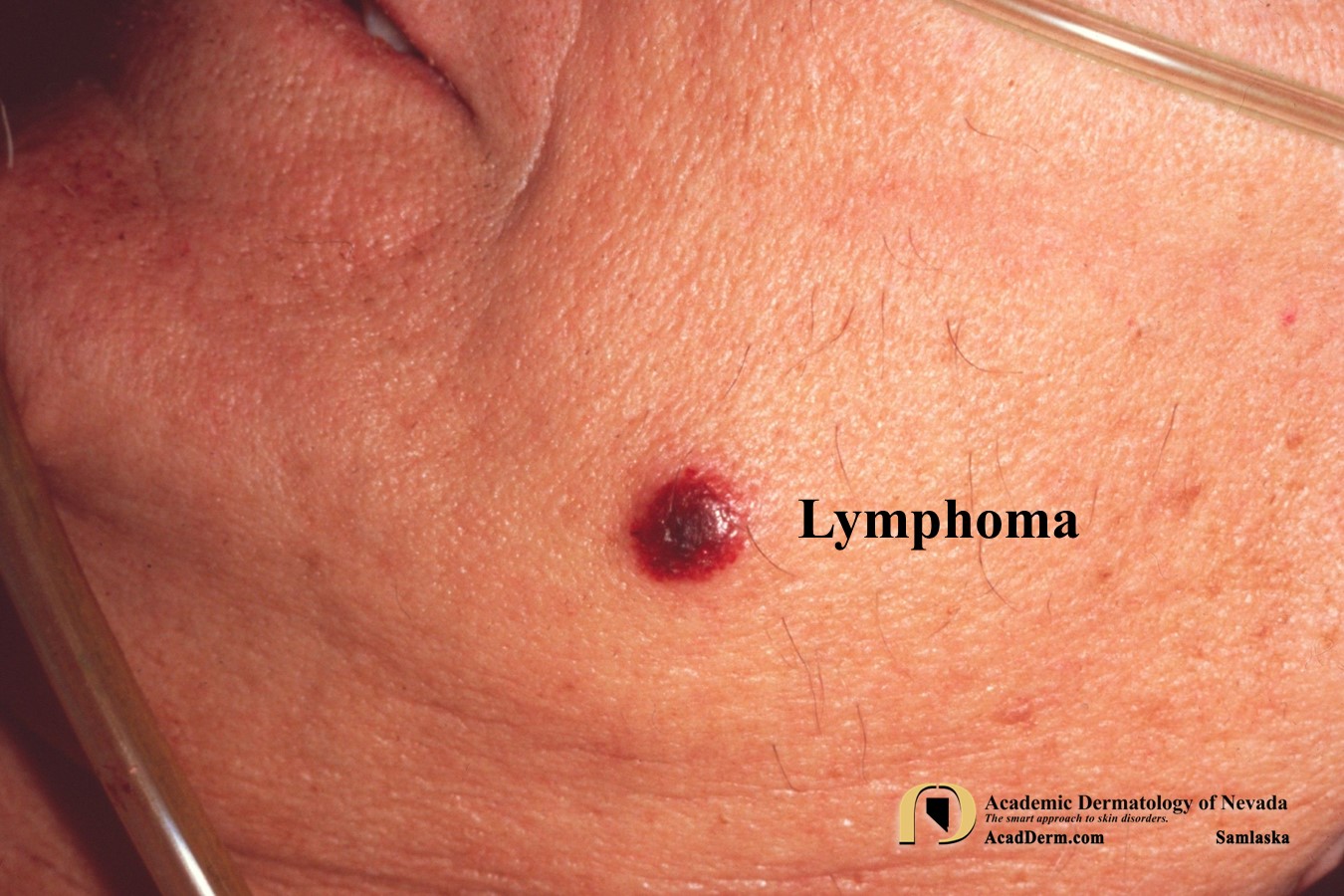 Cutaneous Lymphoma:  Please Contribute To The Leukemia & Lymphoma Society…