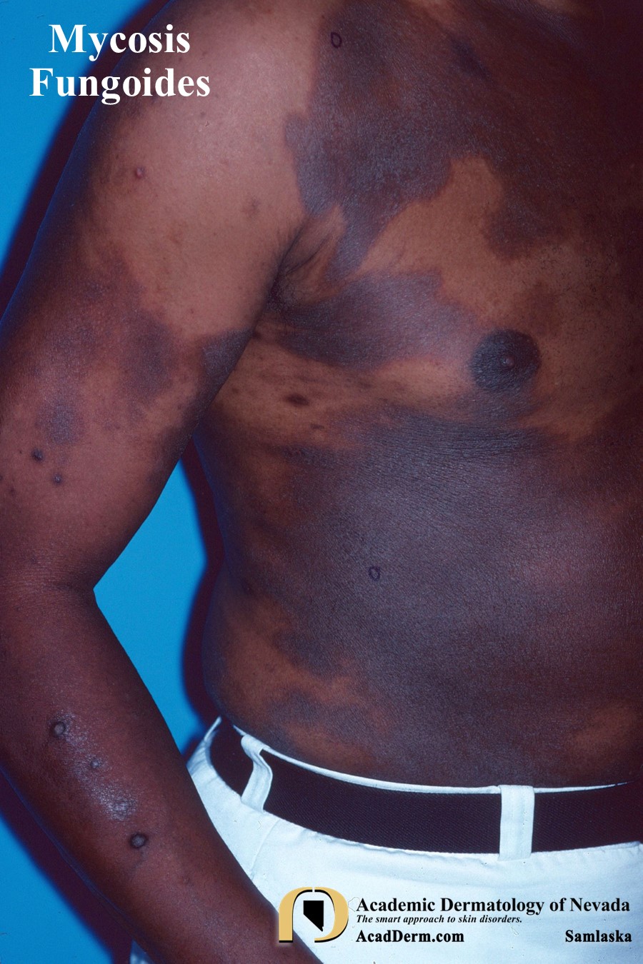 Mycosis Fungoides:  Cutaneous T-cell Lymphoma…